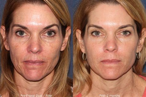 5 Benefits Of Fractional Lasers For Skin Resurfacing Cosmetic Laser