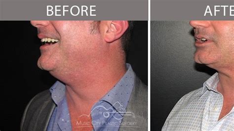 Doctors See Surge In Men Seeking Surgery Free Double Chin Solution