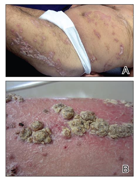 Unilateral Verrucous Psoriasis Mdedge Dermatology
