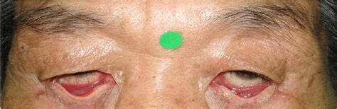 The Photograph Shows The Both Lower Palpebral Conjunctival Mass