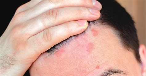 Red Spots On Scalp Pictures Causes And Treatments