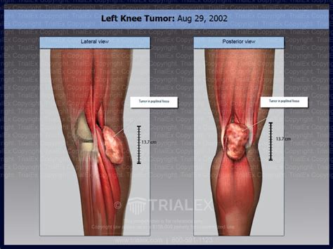 Left Knee Tumor Trial Exhibits Inc