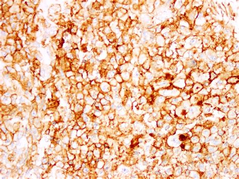 Pathology Outlines Extrarenal Rhabdoid Tumor