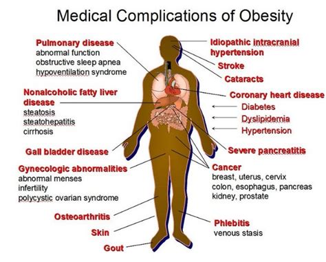 the 20 medical complications of obesity health issues solution