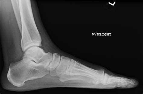 21 - Treatment of Painful Big Toes: Utilizing BioPro Hemi-Implant