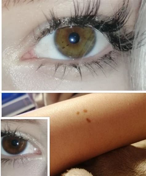 The Freckle On My Arm Matches The Freckle On My Left Eye Rheterochromia