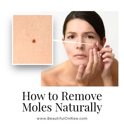 Skin Moles Removal And Prevention Beautiful On Raw Skin Moles
