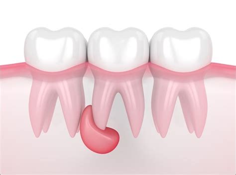 What Is A Dental Cyst Turkey Istanbul Medical