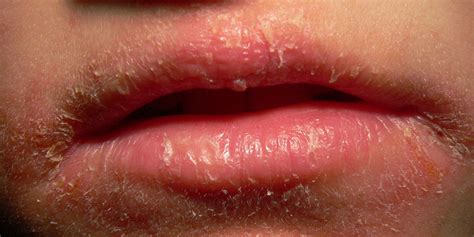 Perioral Dermatitis What To Know About This Annoying Red Face Rash Self
