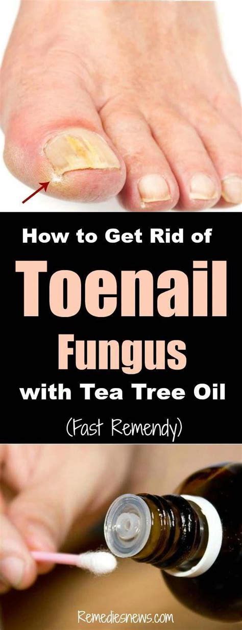 How To Get Rid Of Toenail Fungus With Tea Tree Oil Fast Remedy Here