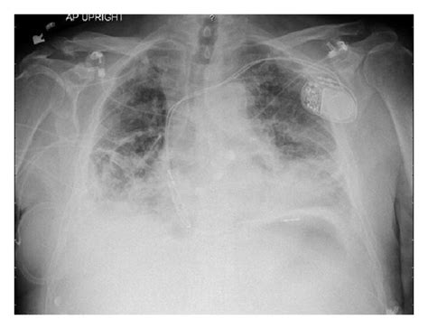 Chest X Ray On Presentation Showing Bilateral Lower Lobe Consolidations