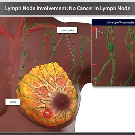 Lymph Node Involvement No Cancer In Lymph Node Trialexhibits Inc