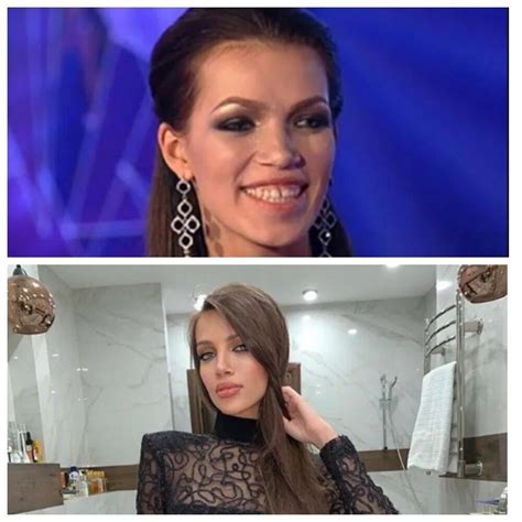 Инесса шевчук фото до и после пластики фото