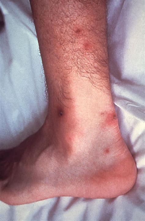 Acute Infectious Arthritis Musculoskeletal And Connective Tissue