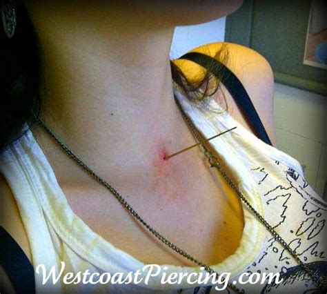 This Photo Is Of A Microdermal That Was Lost In Her Neck She Had An Infection And Chose To