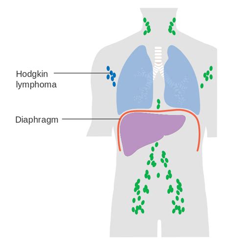 Stage 1 Follicular Non Hodgkin Lymphoma Diagnosis