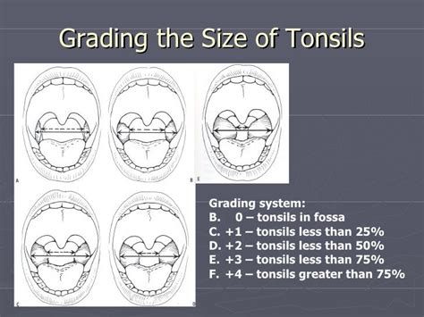 Tonsils And Adenoids Disorders Grading System