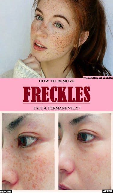 How To Remove Freckles Fast And Permanently At Home Freckle Remover