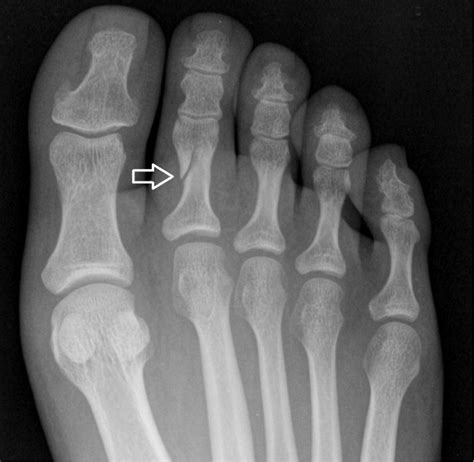 Toe Fracture Oc Foot And Ankle Clinic
