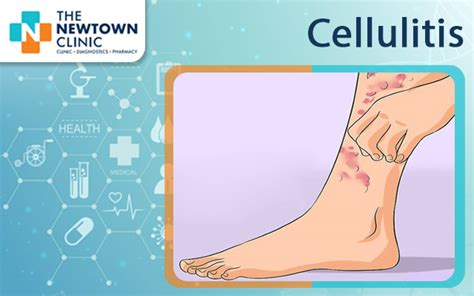 Cellulitis Symptoms And Causes The Newtown Clinic