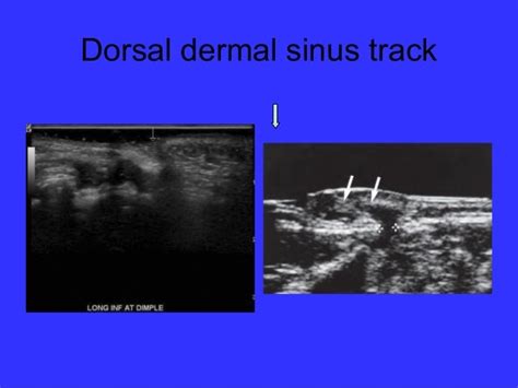 Neonatal Spine Ultrasoundnormal And Abnormal Findings