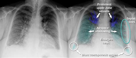 Chest X Ray Cardiac Disease Upper Zone Vascular Prominence