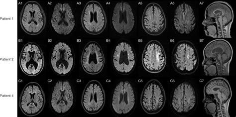 Brain Mri Findings Of Three Patients With Alsp The First And Second