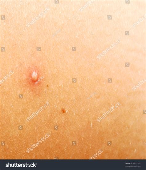 Human Skin Pimple Foto De Stock 85117267 Shutterstock