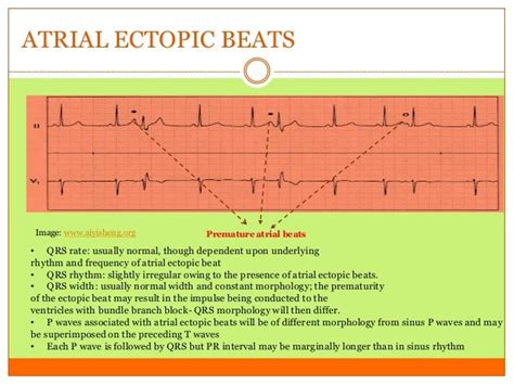 Atrial Ectopic Beats