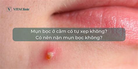 Bí Quyết Xử Lý Mụn Bọc Có Nên Nặn Không Hiệu Quả Và An Toàn