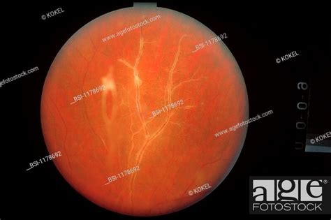 Retinal Phlebitis Phlebitis Of Retinal Artery Stock Photo Picture And