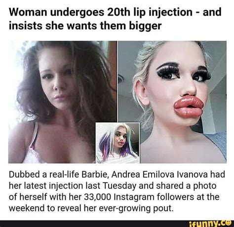 Woman Undergoes Th Lip Injection And Insists She Wants Them Bigger