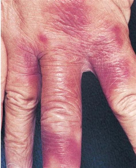Caso 68 Infecciones Por Erysipelothrix Rhusiopathiae Guía