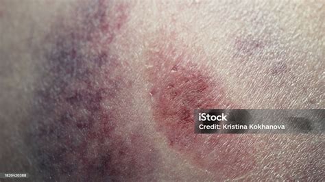 Big Bruise Hematoma After Hit On Human Body Skin Congestion Macro