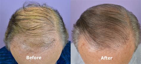 Fut Hair Transplant On Year Old Male Hair Restoration Of The South