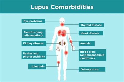 Lupus Complications What Lupus Patients Need To Know