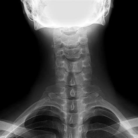 3d Ct Left Distal Cervical Rib Made Pseudoarticular Joint With Left