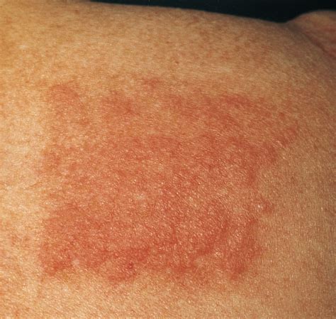 Lupus Erythematosus Tumidus Dermatology Jama Dermatology The Jama