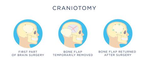 Craniotomy Stock Photos Pictures And Royalty Free Images Istock