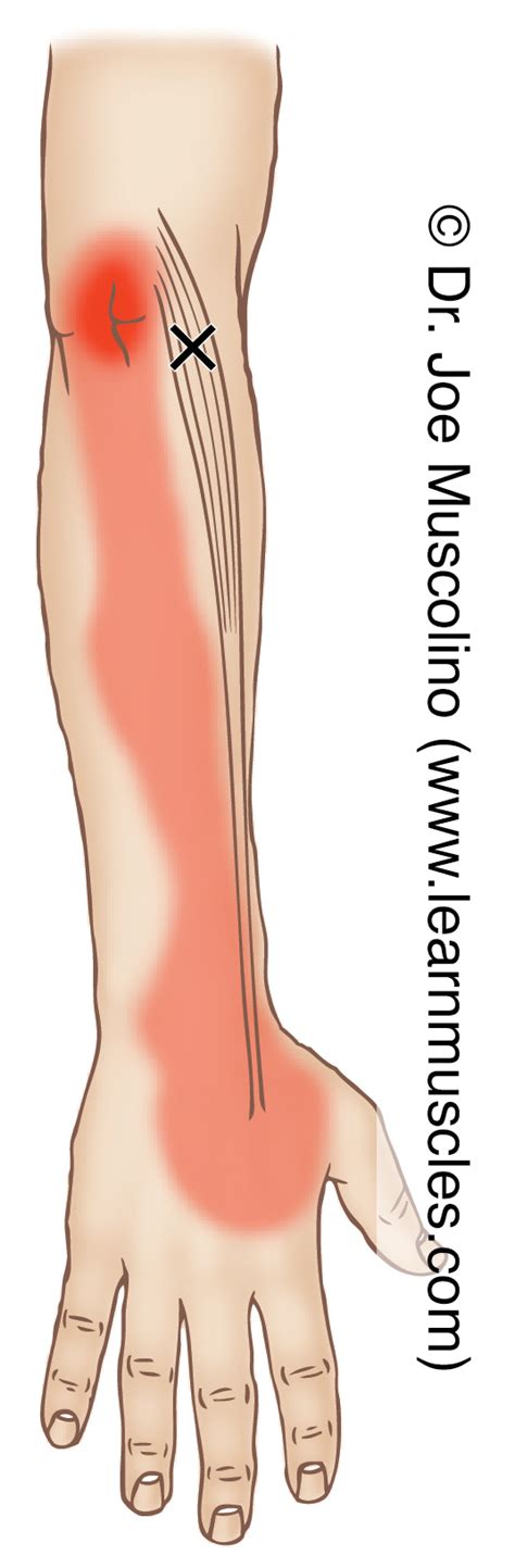 Extensor Carpi Radialis Longus Trigger Points Learn Muscles