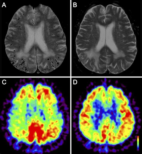 Figure1mri And Pet Scans Of Case 1 A Brain Mri Showed Cortical And