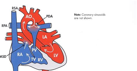 Heart Defects For Everyone Hypoplasia Of The Right Ventricle