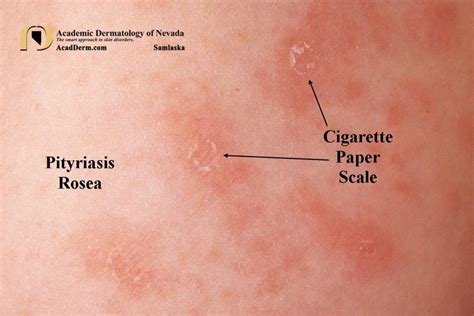 Pityriasis Rosea It Starts With A Herald Patch Academic