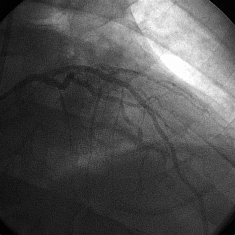 Angle aob= angle boc = angle cod =angle doe = angle eof = a. Simultaneous Subacute Stent Thrombosis of Two Drug-Eluting Stents in the Left Anterior ...