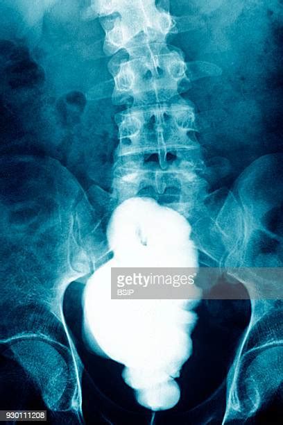 Pelvic X Ray Photos And Premium High Res Pictures Getty Images