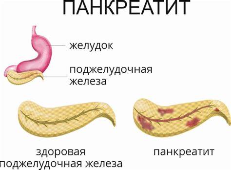 Острый панкреатит диете Панкреатит: симптомы, причины, диагностика, лечение, профилактика Панкреатит: симптомы, причины, диагностика, лечение, профилактика Острый панкреатит диете