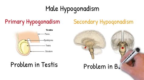 Male Hypogonadism Simply Explained Youtube
