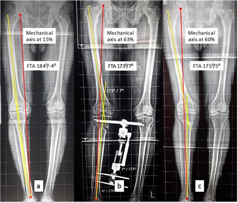 Changes In Limb Alignment A Pre Operative Femoro Tibial Angle Fta