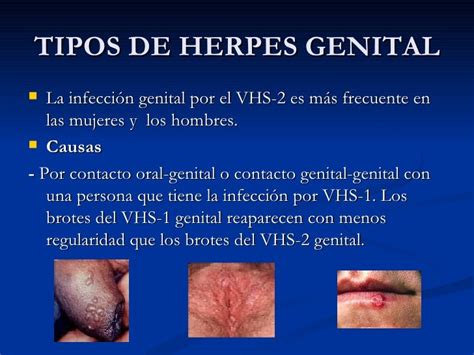 que es el herpes genital sintomas causas y como tratar la enfermedad images
