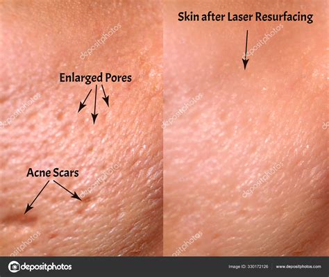 Large Pores Before And After Ph